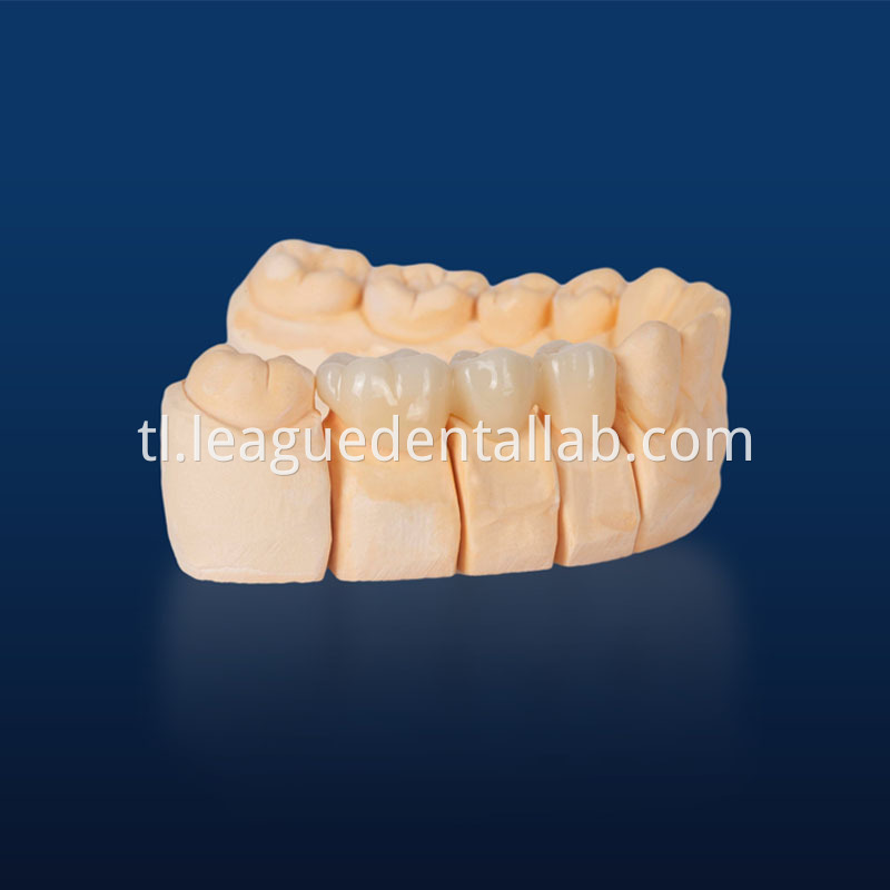 Full Zirconia crown,Full contour zirconia,Solid Zirconia,Zirconia,Monolithic Zirconia